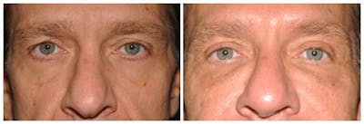Upper Eyelids Before & After Gallery - Patient 289155 - Image 1