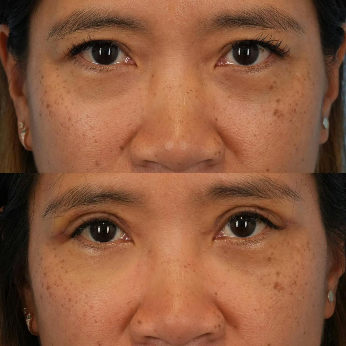 Upper Eyelids Before & After Gallery - Patient 286150 - Image 2