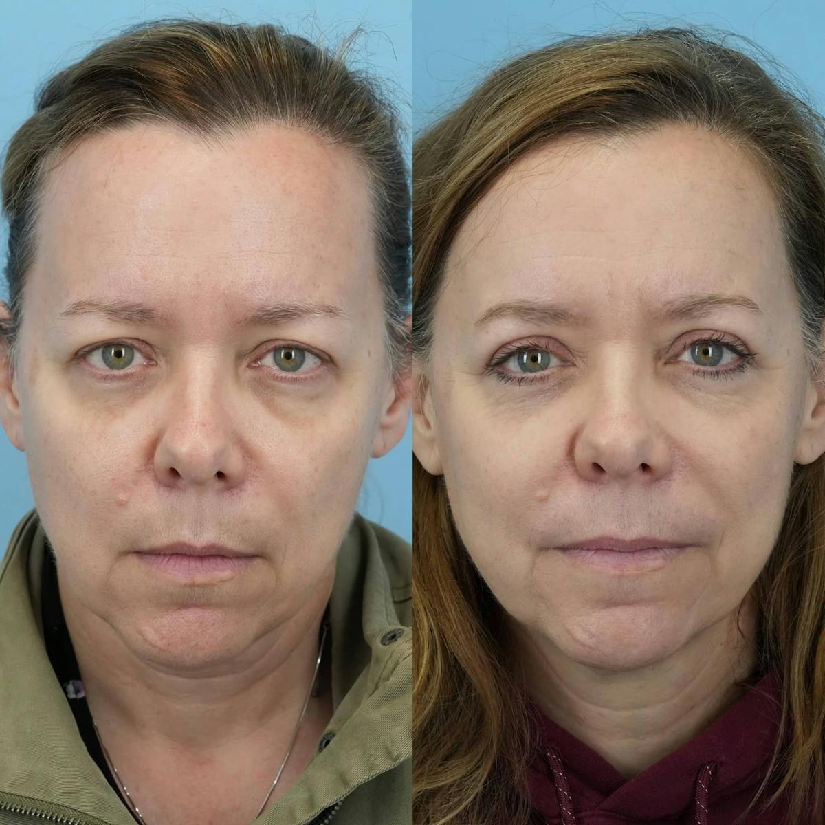 Upper Eyelids Before & After Gallery - Patient 346167 - Image 1