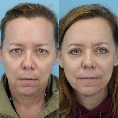Upper Eyelids Before & After Gallery - Patient 346167 - Image 1