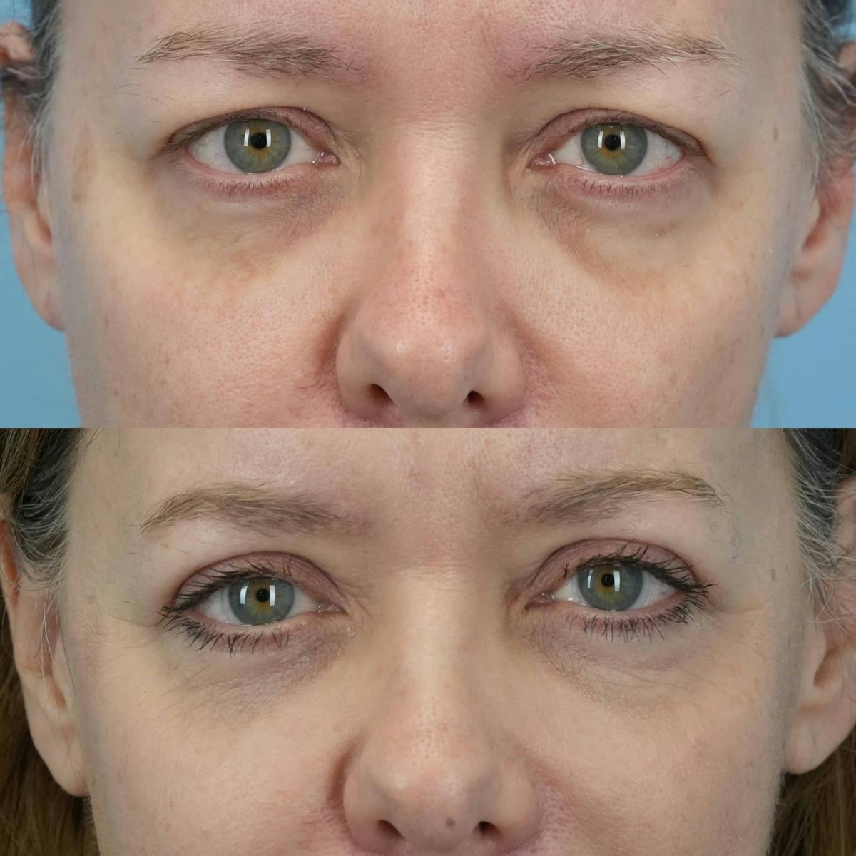 Upper Eyelids Before & After Gallery - Patient 346167 - Image 3