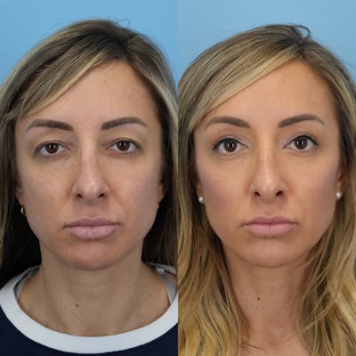 Upper Eyelids Before & After Gallery - Patient 263762 - Image 1