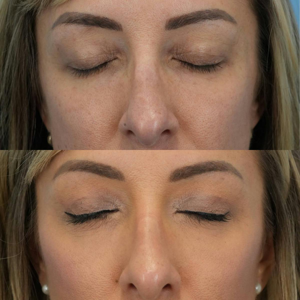 Upper Eyelids Before & After Gallery - Patient 263762 - Image 2