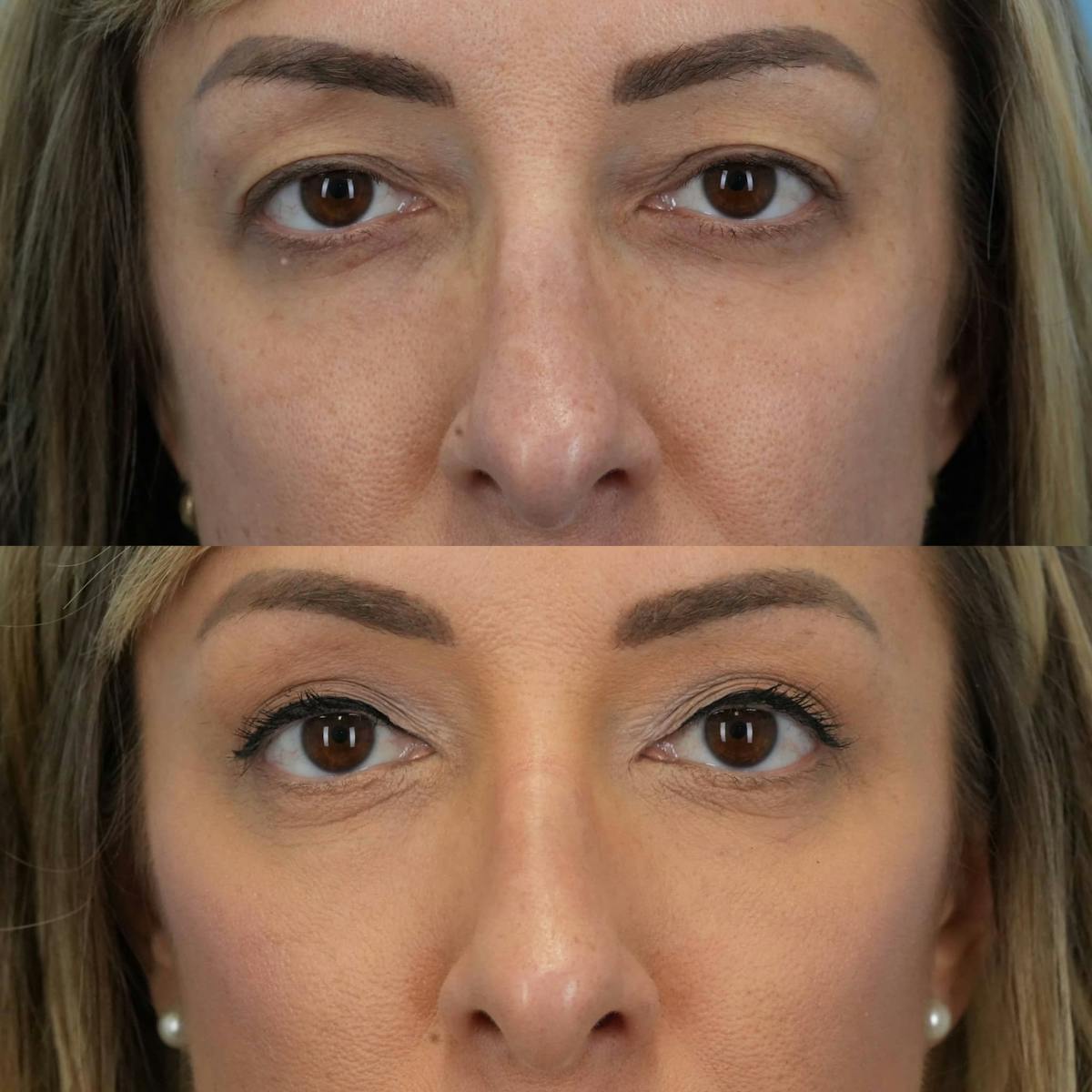 Upper Eyelids Before & After Gallery - Patient 263762 - Image 3