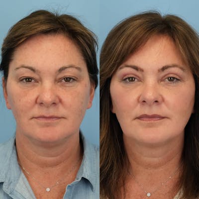Upper Eyelids Before & After Gallery - Patient 254396 - Image 1