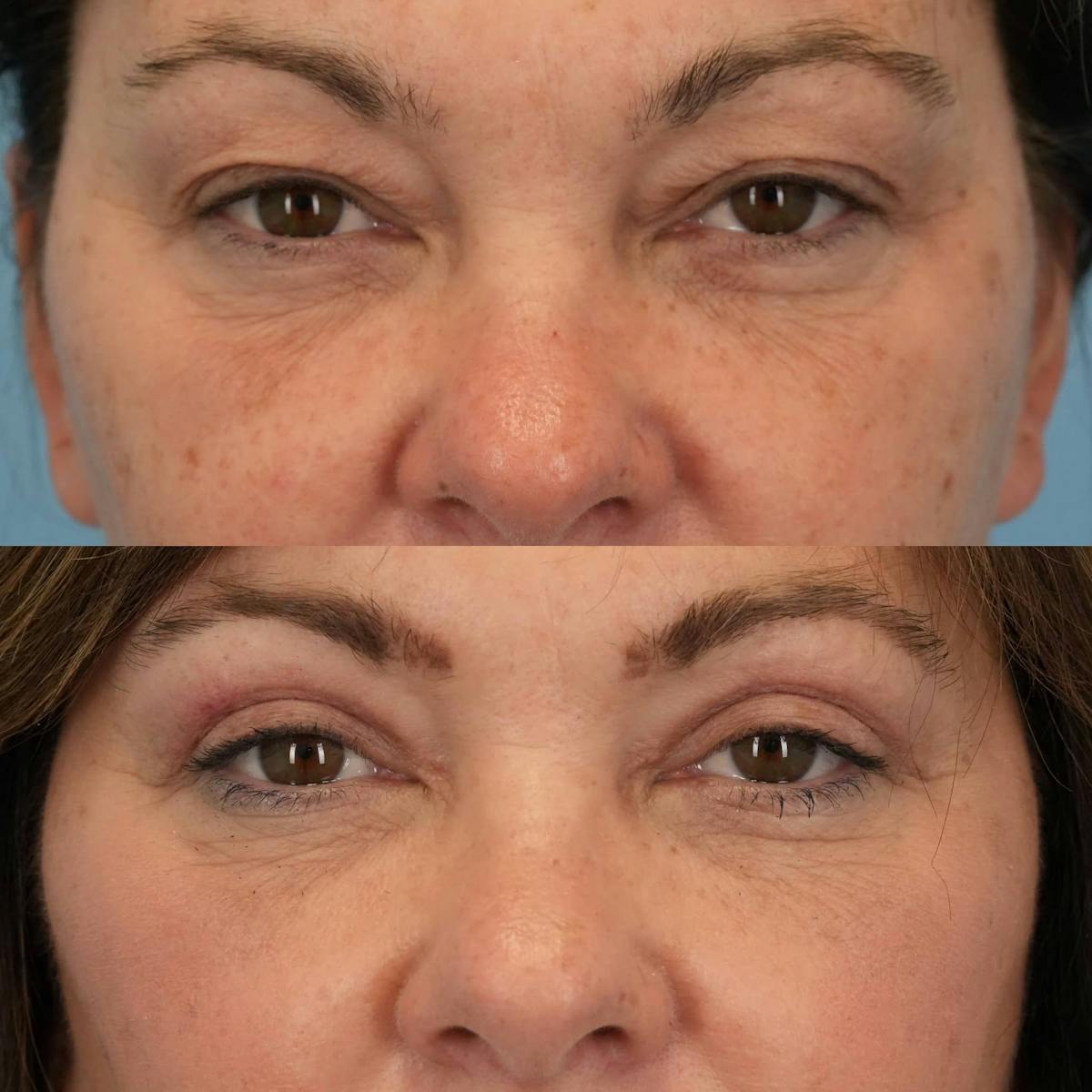 Upper Eyelids Before & After Gallery - Patient 254396 - Image 3