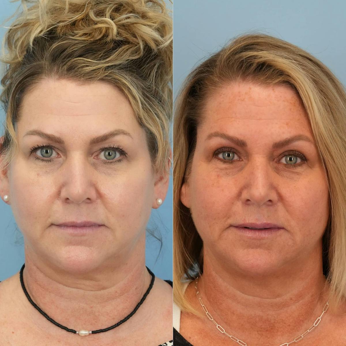Upper Eyelids Before & After Gallery - Patient 289571 - Image 1