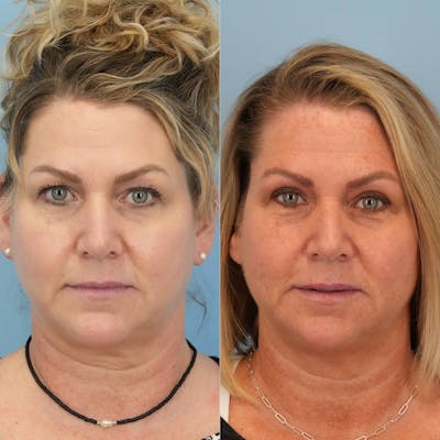 Upper Eyelids Before & After Gallery - Patient 289571 - Image 1
