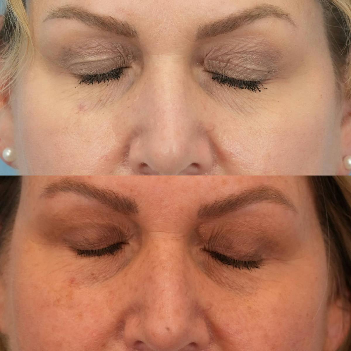 Upper Eyelids Before & After Gallery - Patient 289571 - Image 2