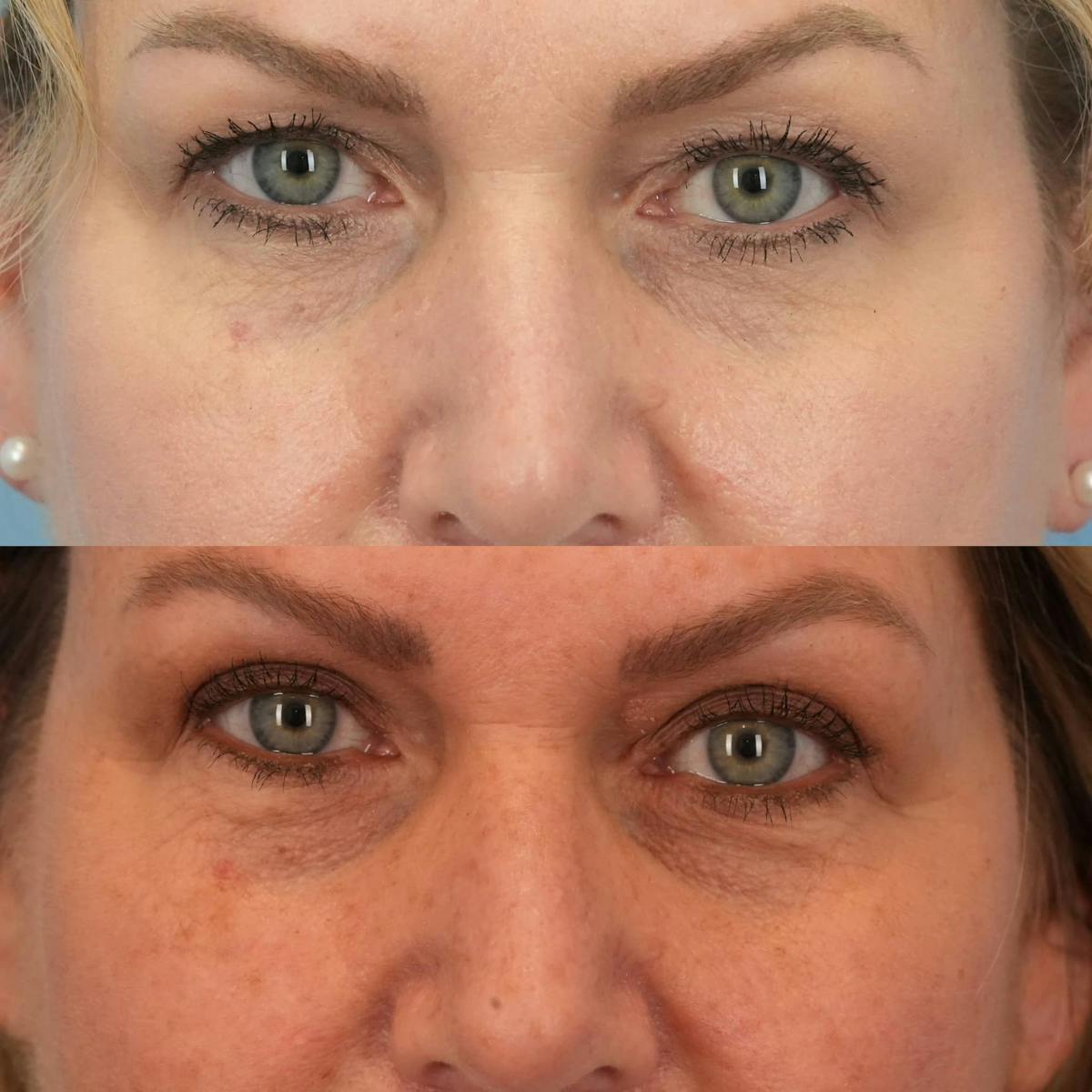 Upper Eyelids Before & After Gallery - Patient 289571 - Image 3