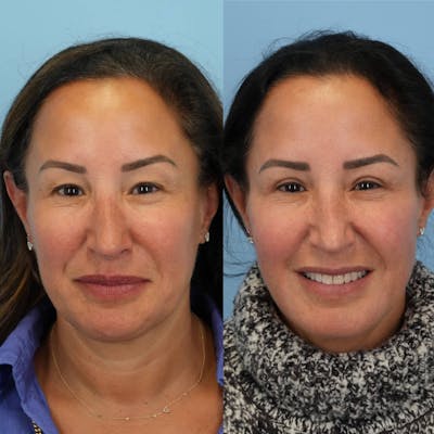 Upper Eyelids Before & After Gallery - Patient 222598 - Image 1