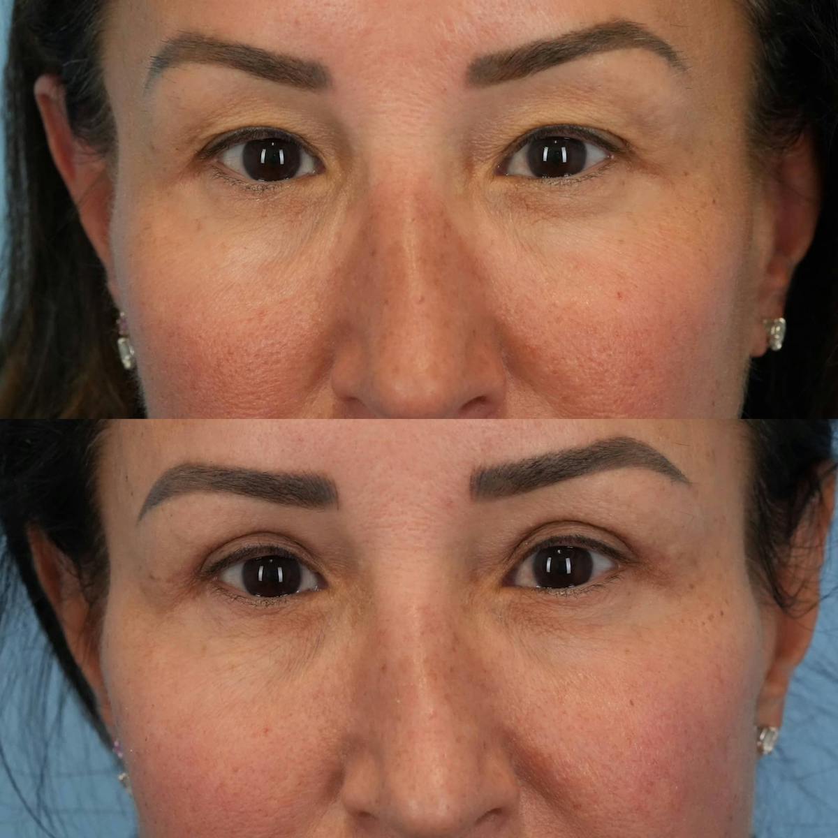 Upper Eyelids Before & After Gallery - Patient 222598 - Image 2