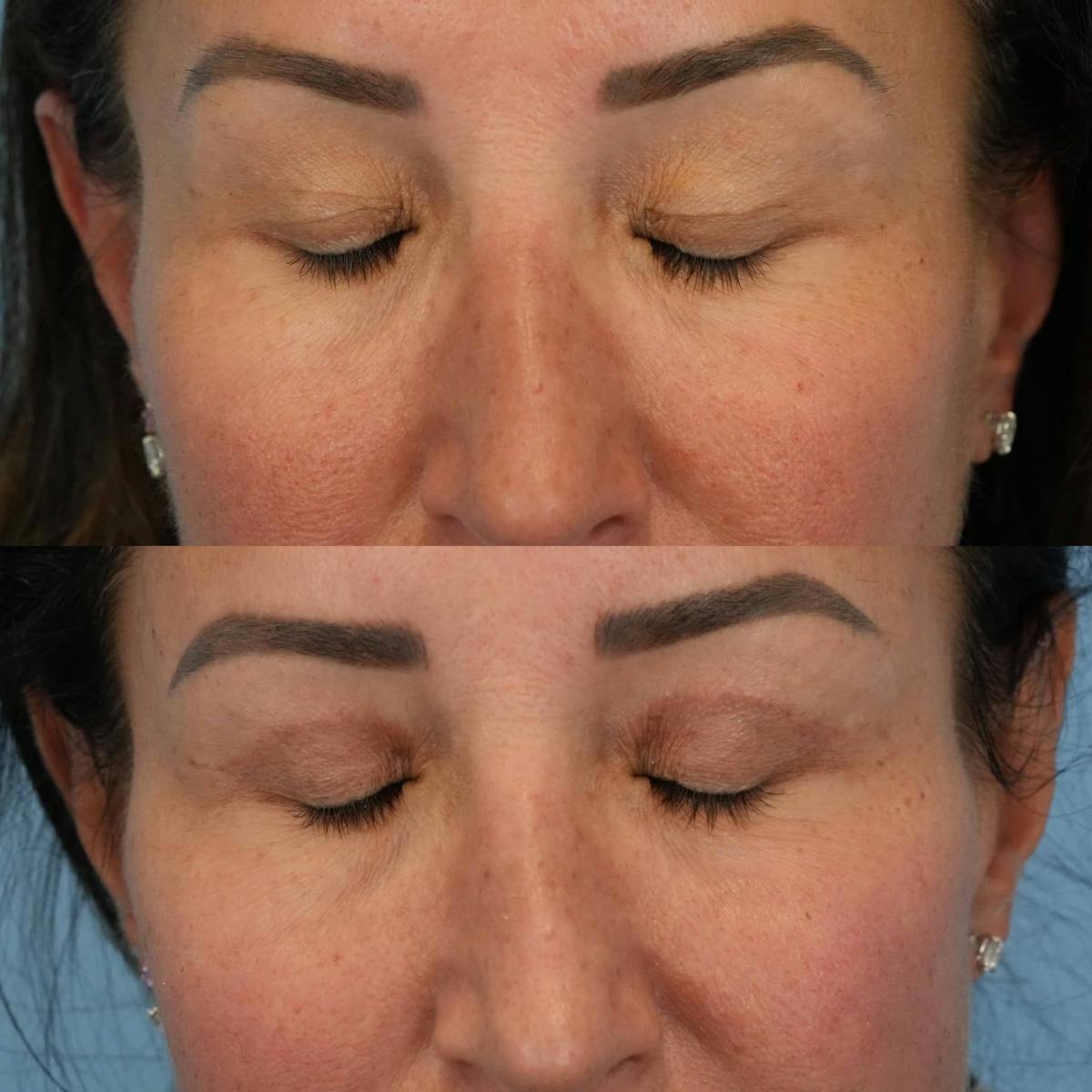 Upper Eyelids Before & After Gallery - Patient 222598 - Image 3