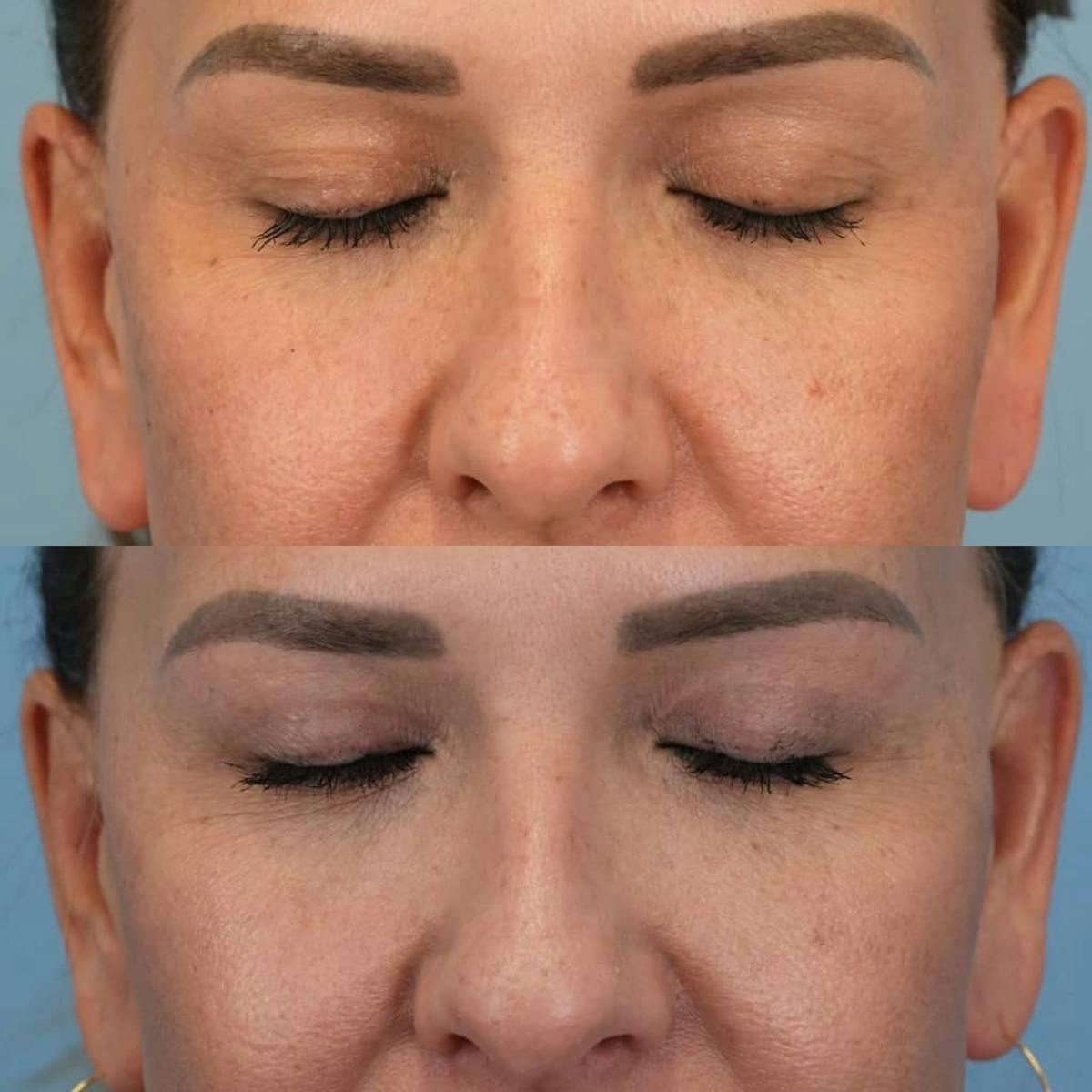 Upper Eyelids Before & After Gallery - Patient 399973 - Image 3