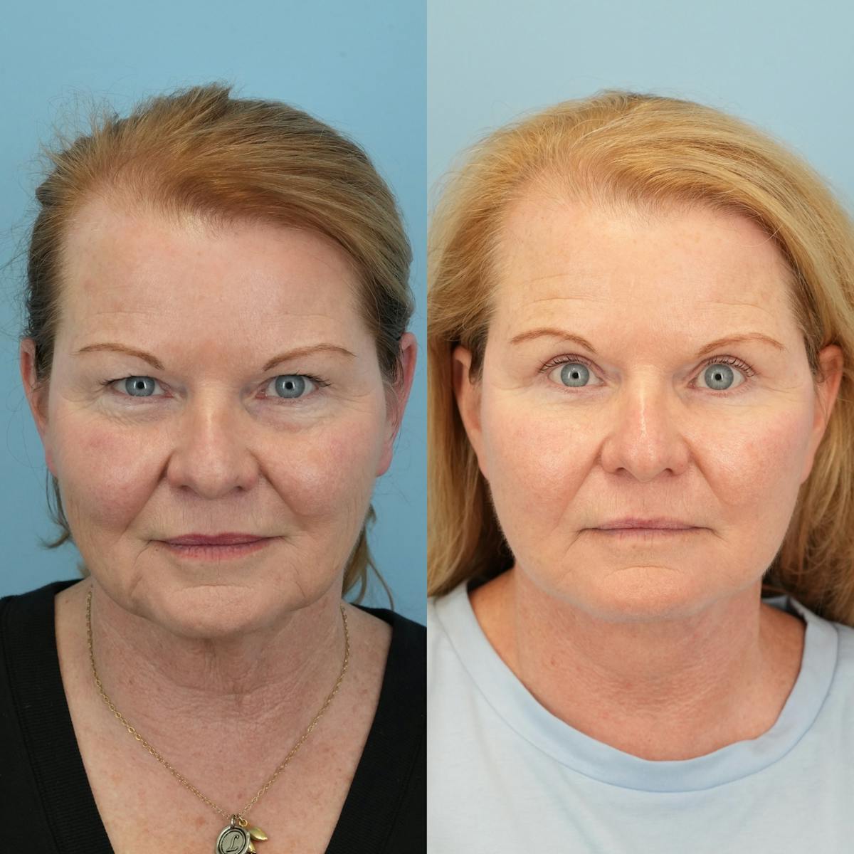 Upper Eyelids Before & After Gallery - Patient 106888 - Image 1