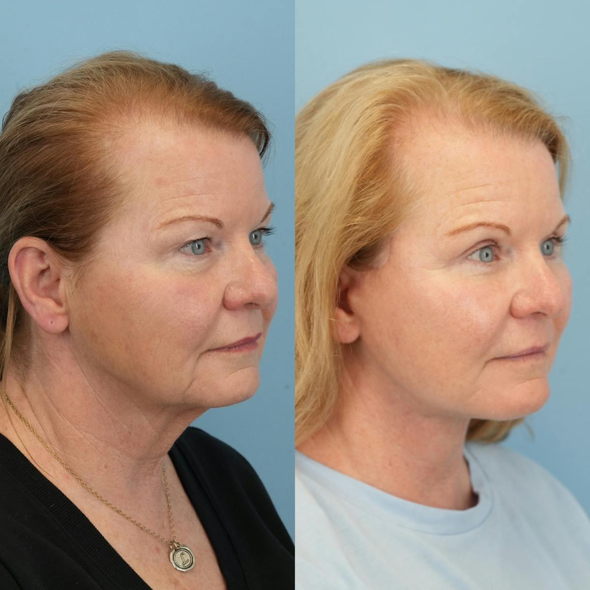 Upper Eyelids Before & After Gallery - Patient 106888 - Image 2