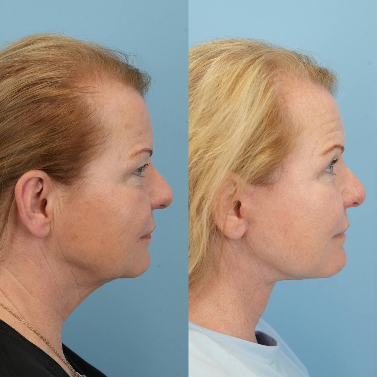Upper Eyelids Before & After Gallery - Patient 106888 - Image 3