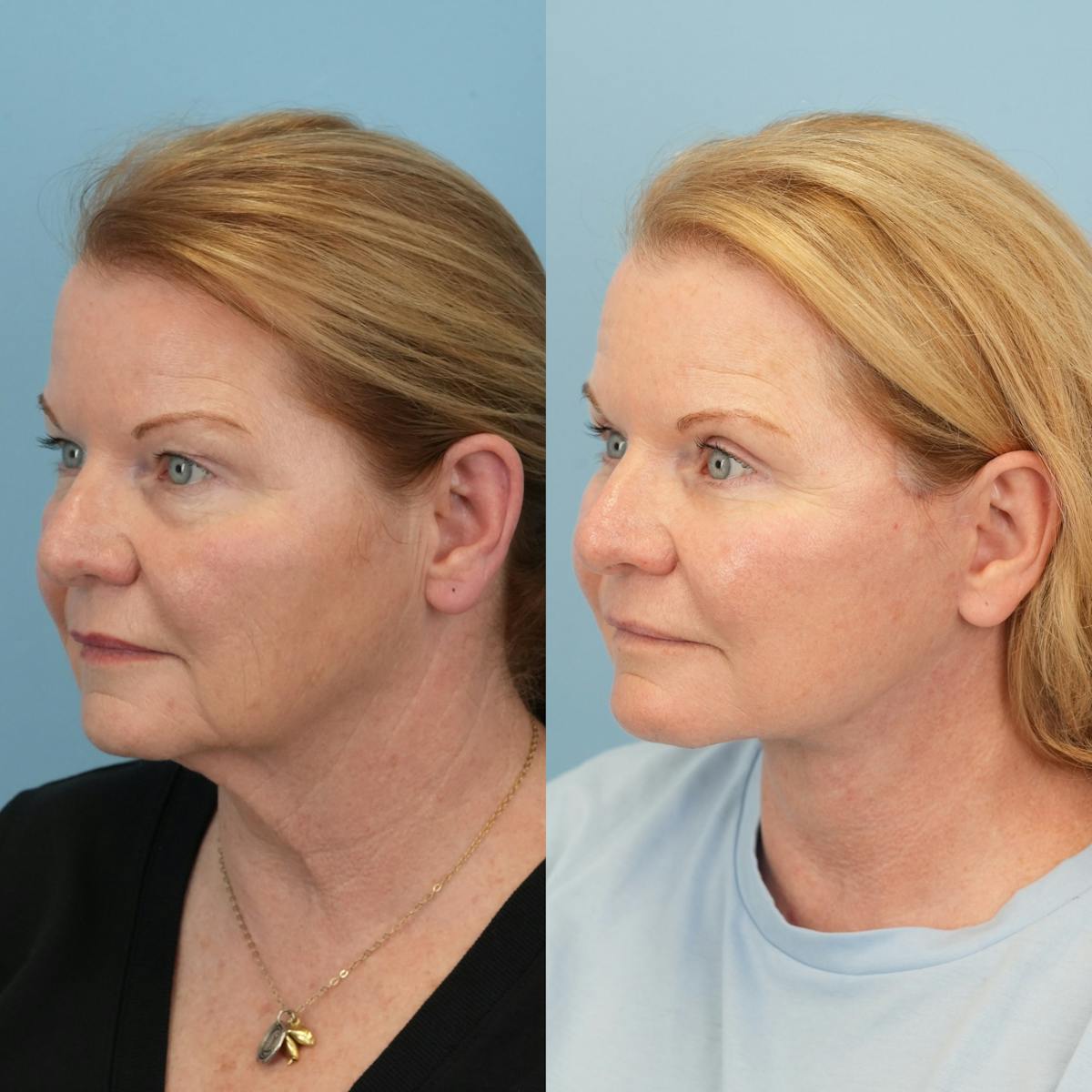 Upper Eyelids Before & After Gallery - Patient 106888 - Image 4