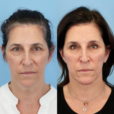 Lower Eyelids Before & After Gallery - Patient 137554 - Image 1