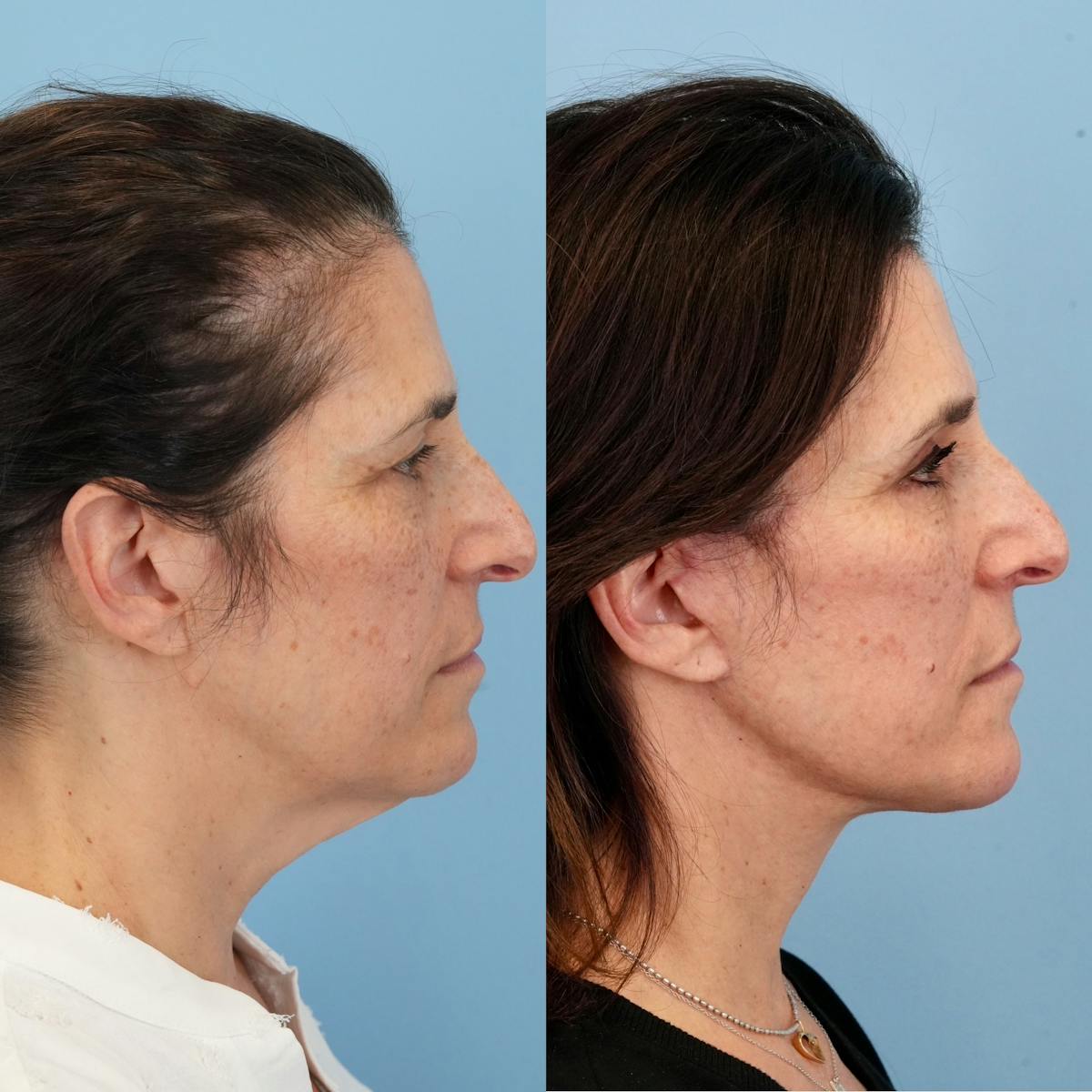 Upper Eyelids Before & After Gallery - Patient 162890 - Image 3