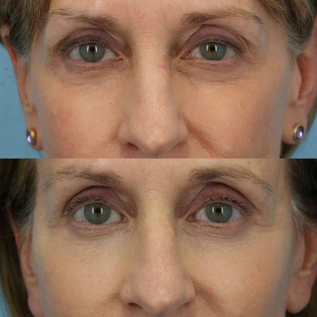 Lower Eyelids Before & After Gallery - Patient 219861 - Image 1