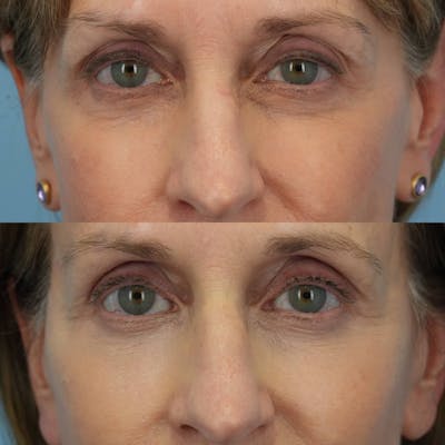Lower Eyelids Before & After Gallery - Patient 219861 - Image 1