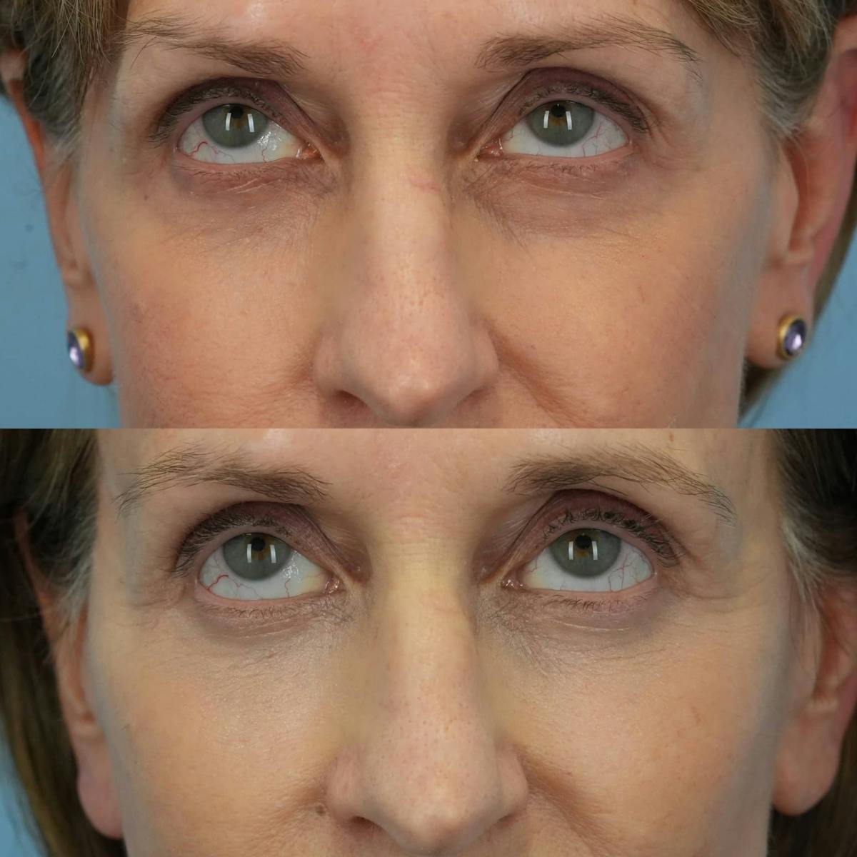 Lower Eyelids Before & After Gallery - Patient 219861 - Image 2