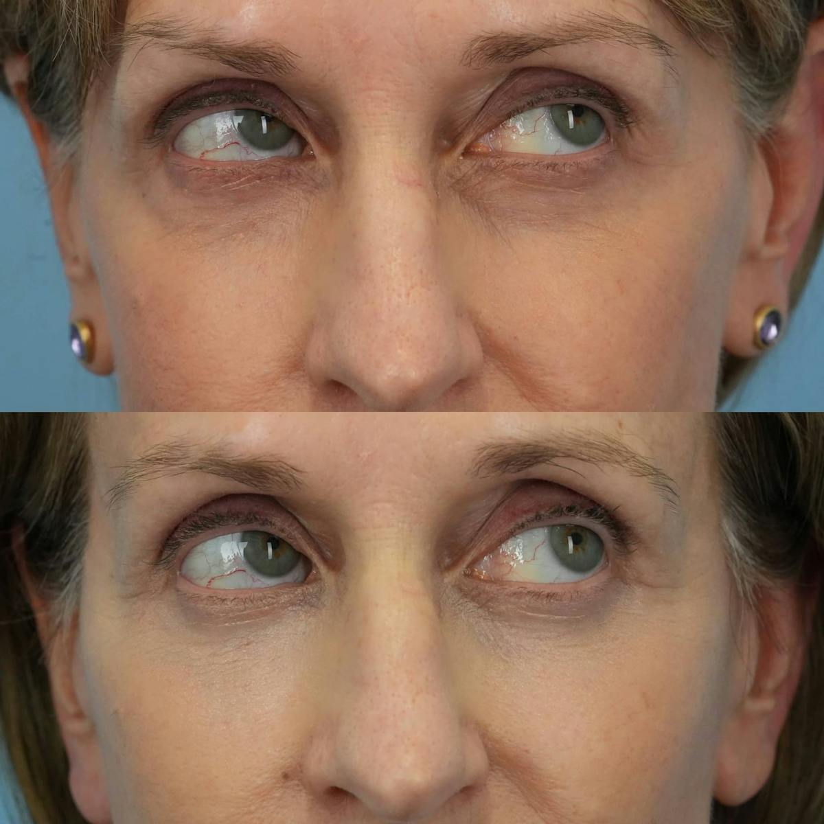 Lower Eyelids Before & After Gallery - Patient 219861 - Image 3