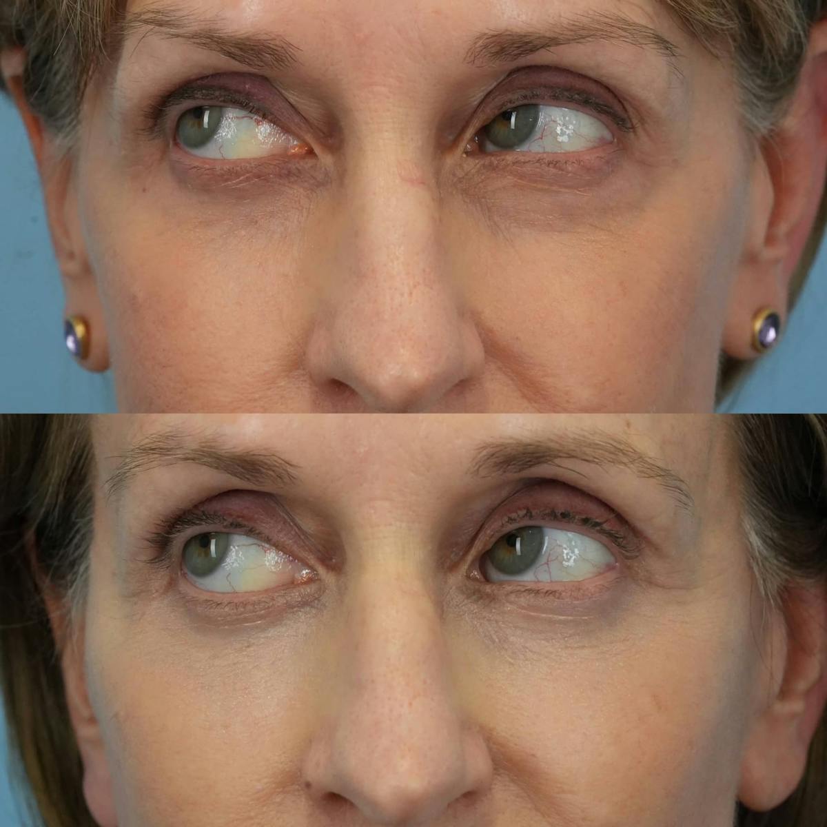 Lower Eyelids Before & After Gallery - Patient 219861 - Image 4