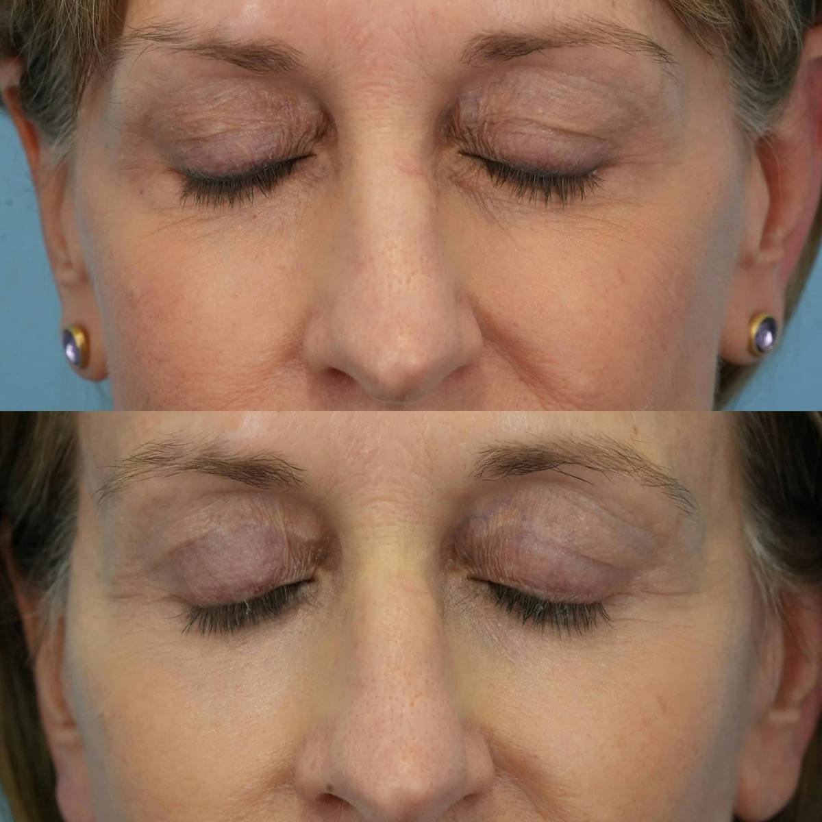 Lower Eyelids Before & After Gallery - Patient 219861 - Image 5