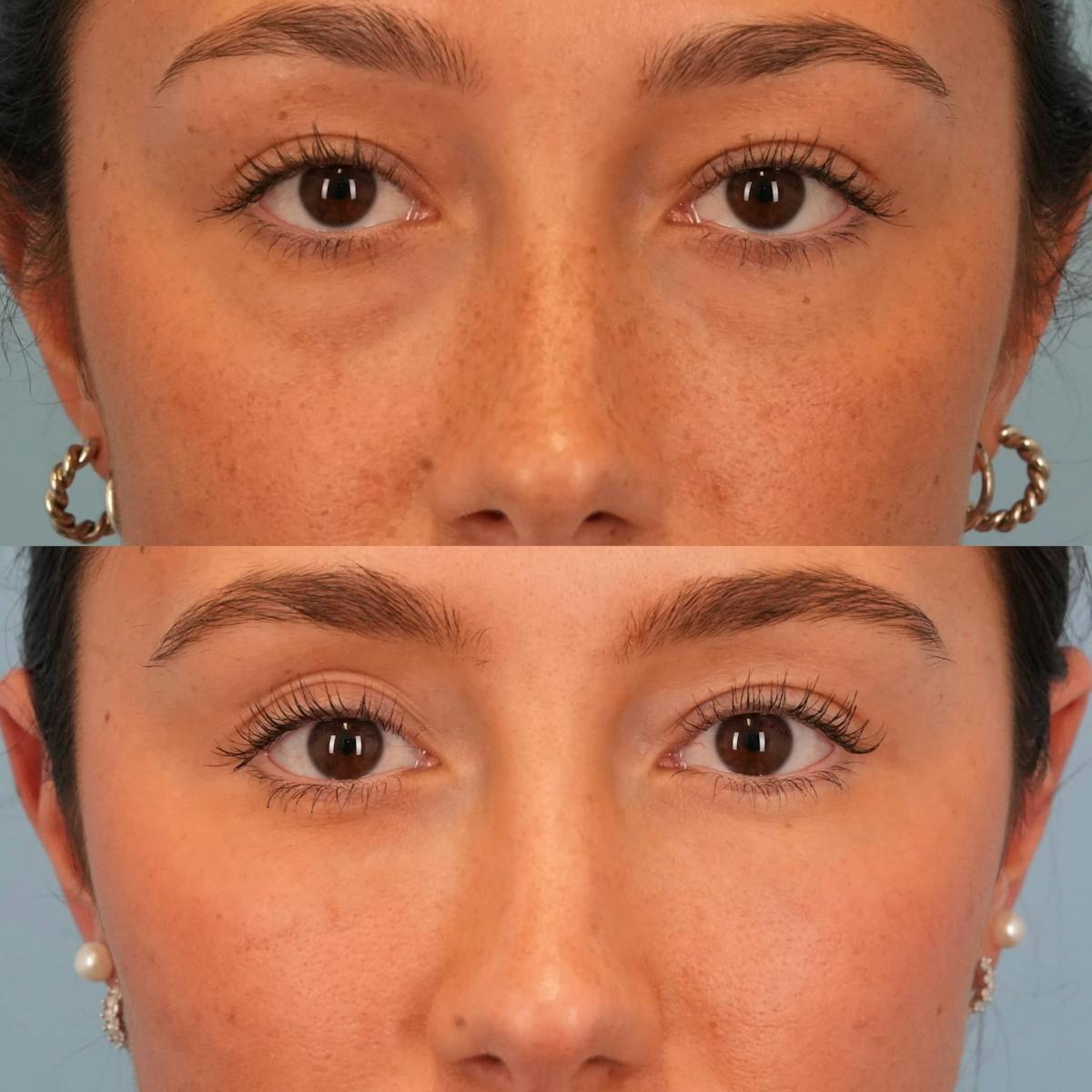 Lower Eyelids Before & After Gallery - Patient 207487 - Image 1