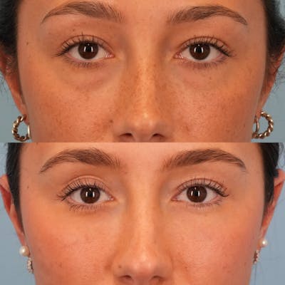 Lower Eyelids Before & After Gallery - Patient 207487 - Image 1