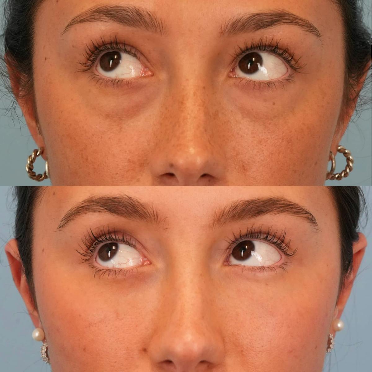 Lower Eyelids Before & After Gallery - Patient 207487 - Image 3