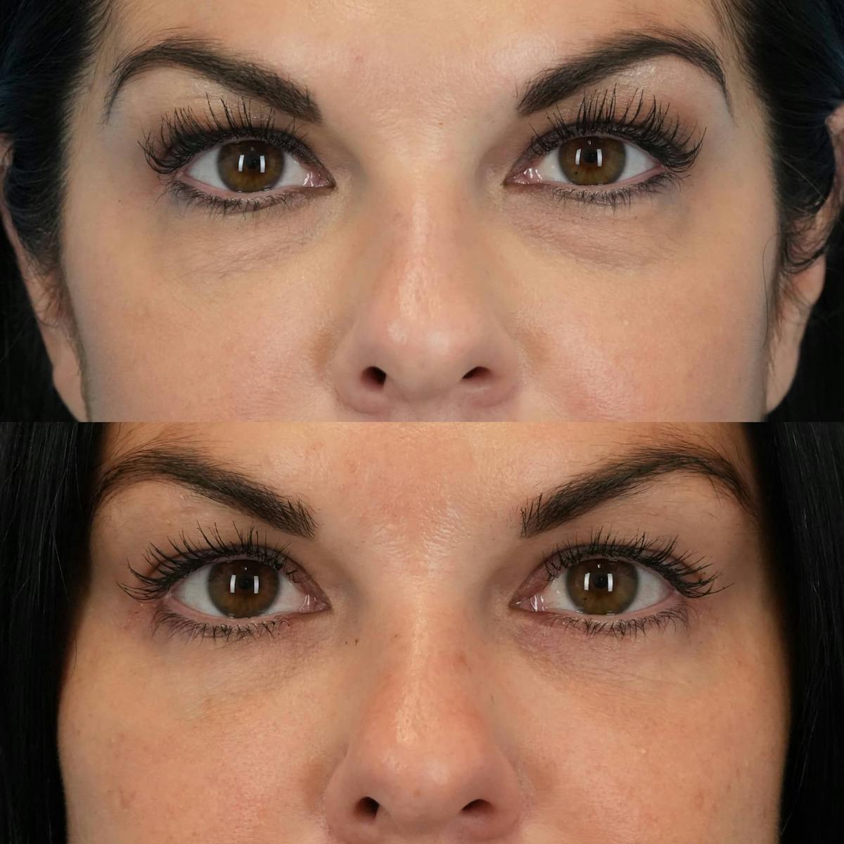 Lower Eyelids Before & After Gallery - Patient 133115 - Image 1