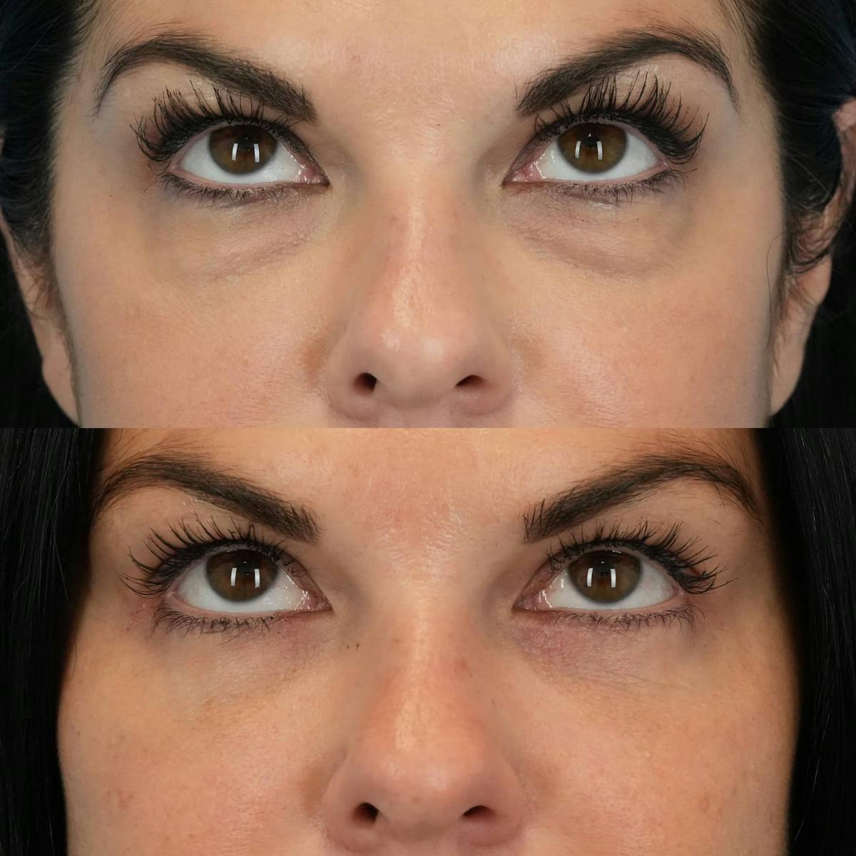 Lower Eyelids Before & After Gallery - Patient 133115 - Image 2