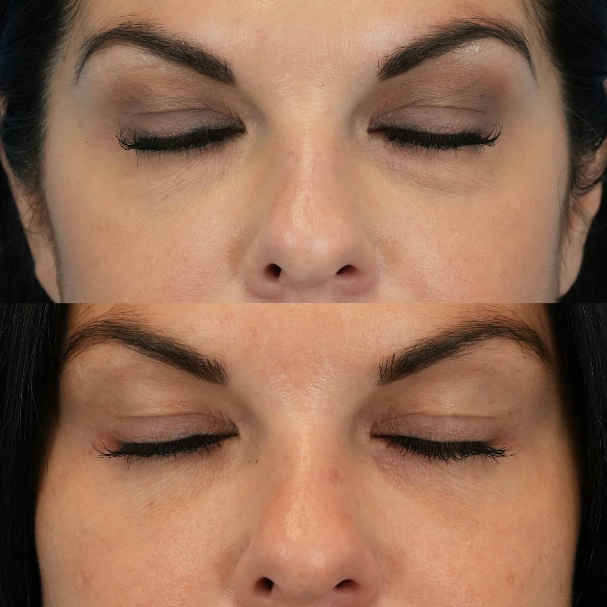 Lower Eyelids Before & After Gallery - Patient 133115 - Image 3