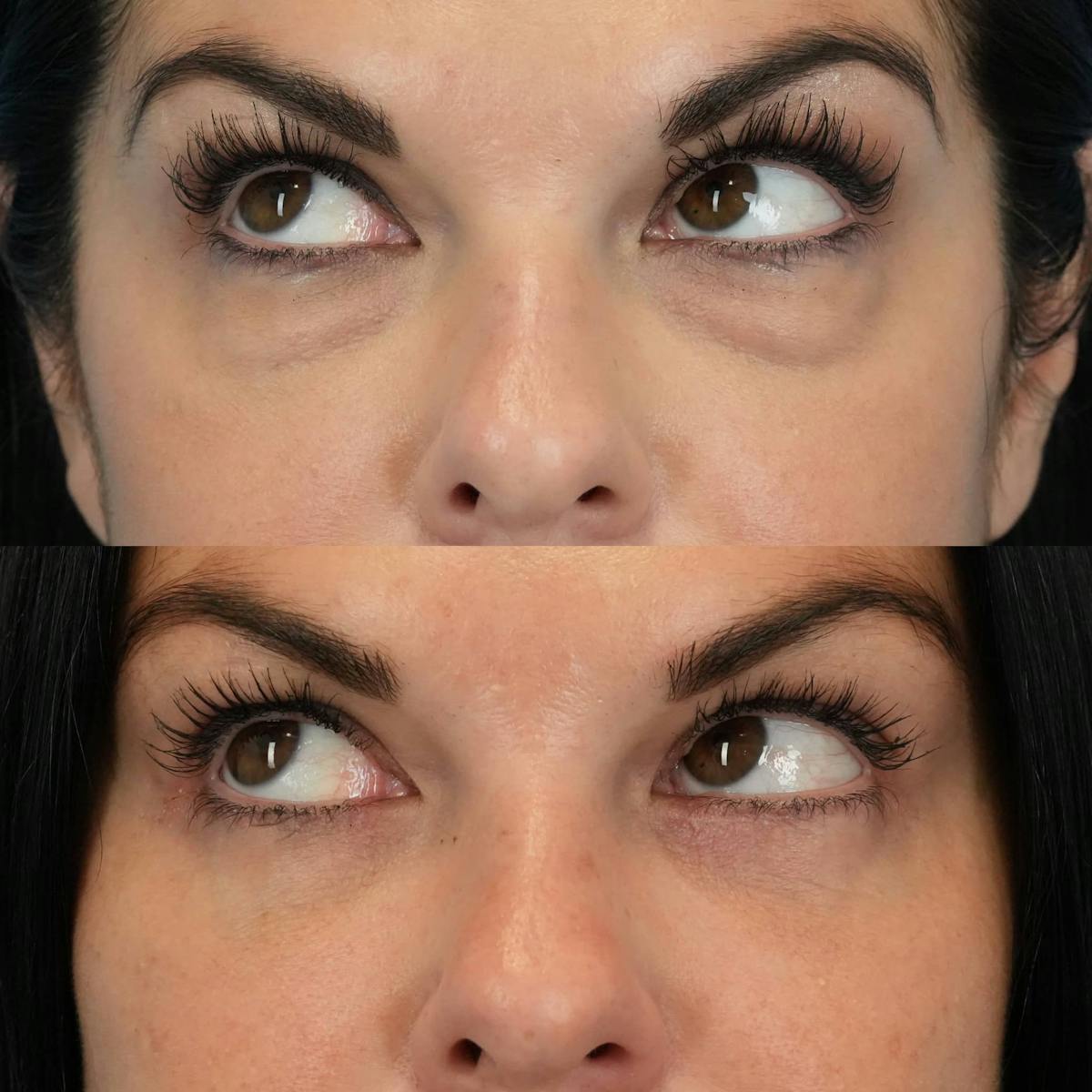 Lower Eyelids Before & After Gallery - Patient 133115 - Image 5