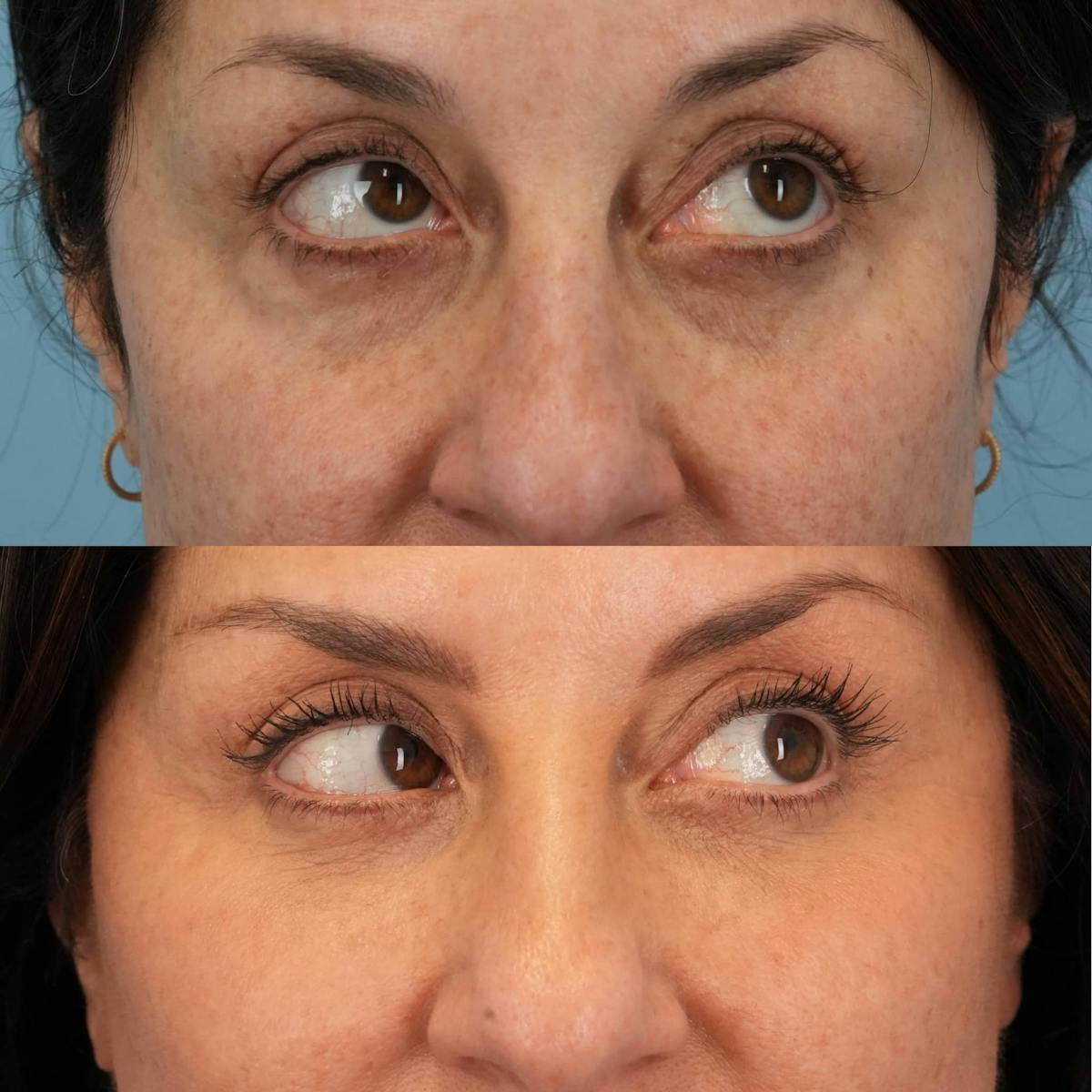 Lower Eyelids Before & After Gallery - Patient 164544 - Image 4