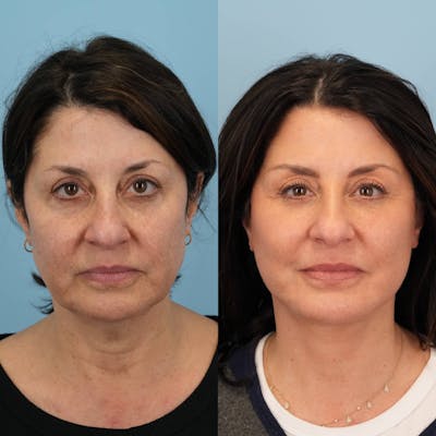 Facelift Before & After Gallery - Patient 264984 - Image 1