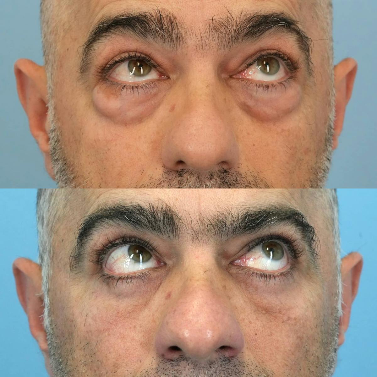 Lower Eyelids Before & After Gallery - Patient 281614 - Image 2