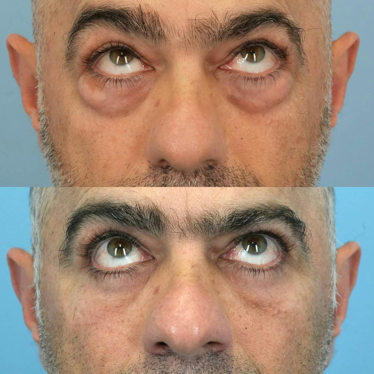 Lower Eyelids Before & After Gallery - Patient 281614 - Image 4