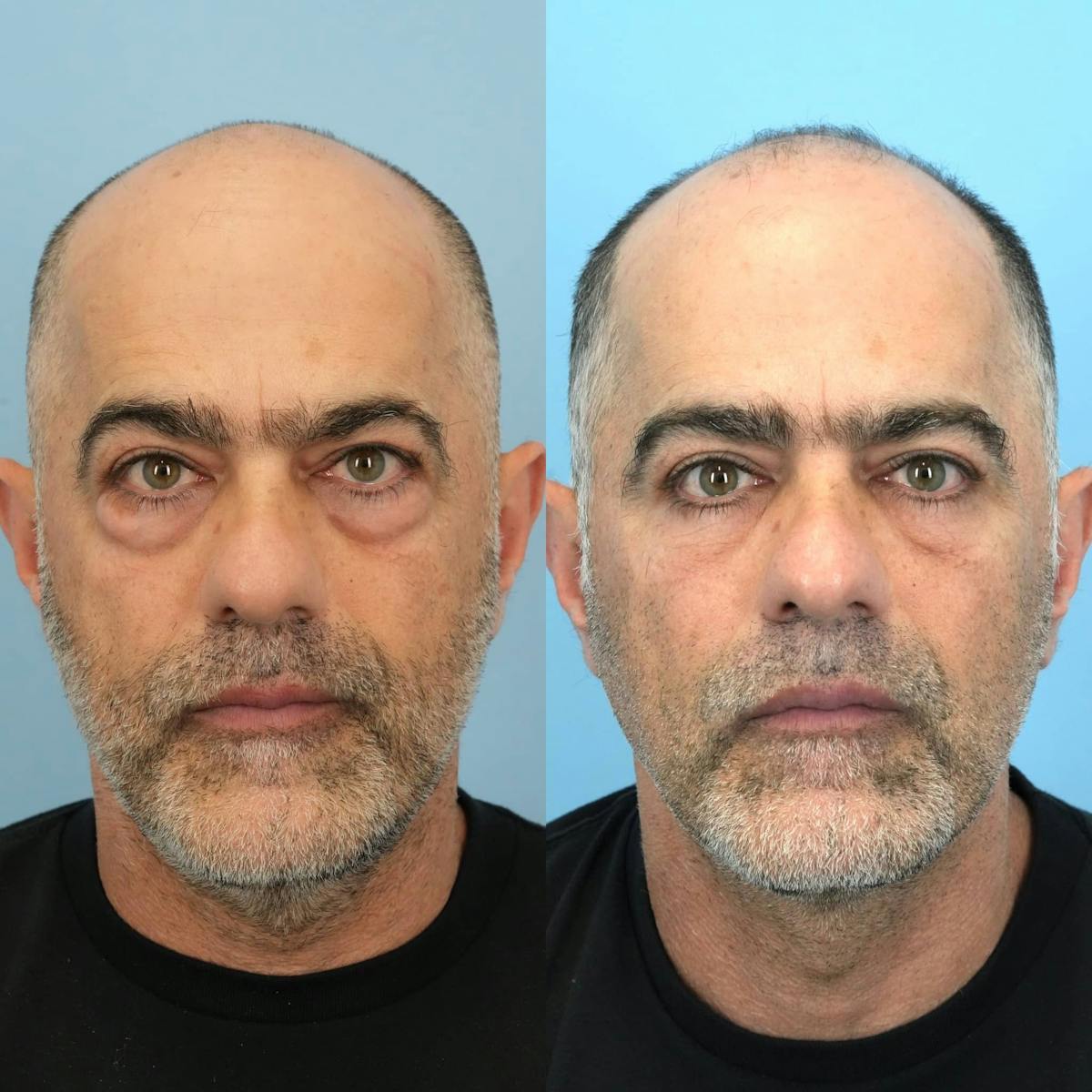 Lower Eyelids Before & After Gallery - Patient 281614 - Image 5