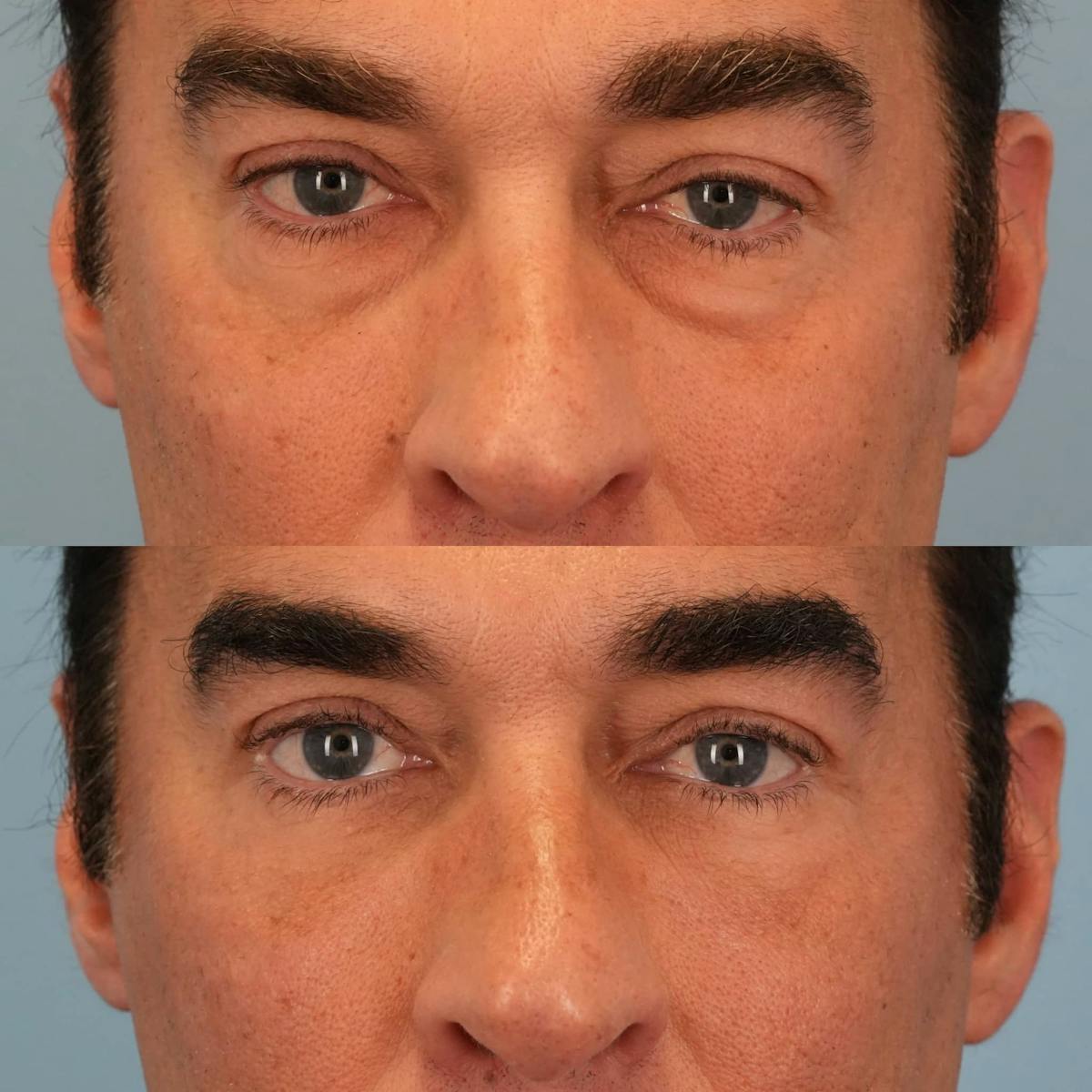 Lower Eyelids Before & After Gallery - Patient 403392 - Image 1