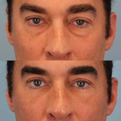 Lower Eyelids Before & After Gallery - Patient 403392 - Image 1