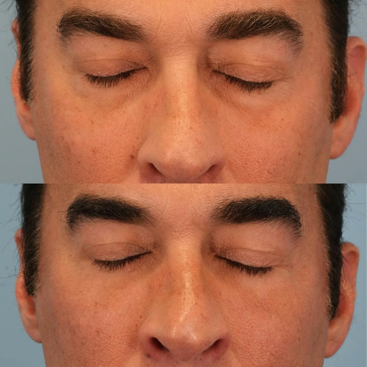 Lower Eyelids Before & After Gallery - Patient 403392 - Image 2