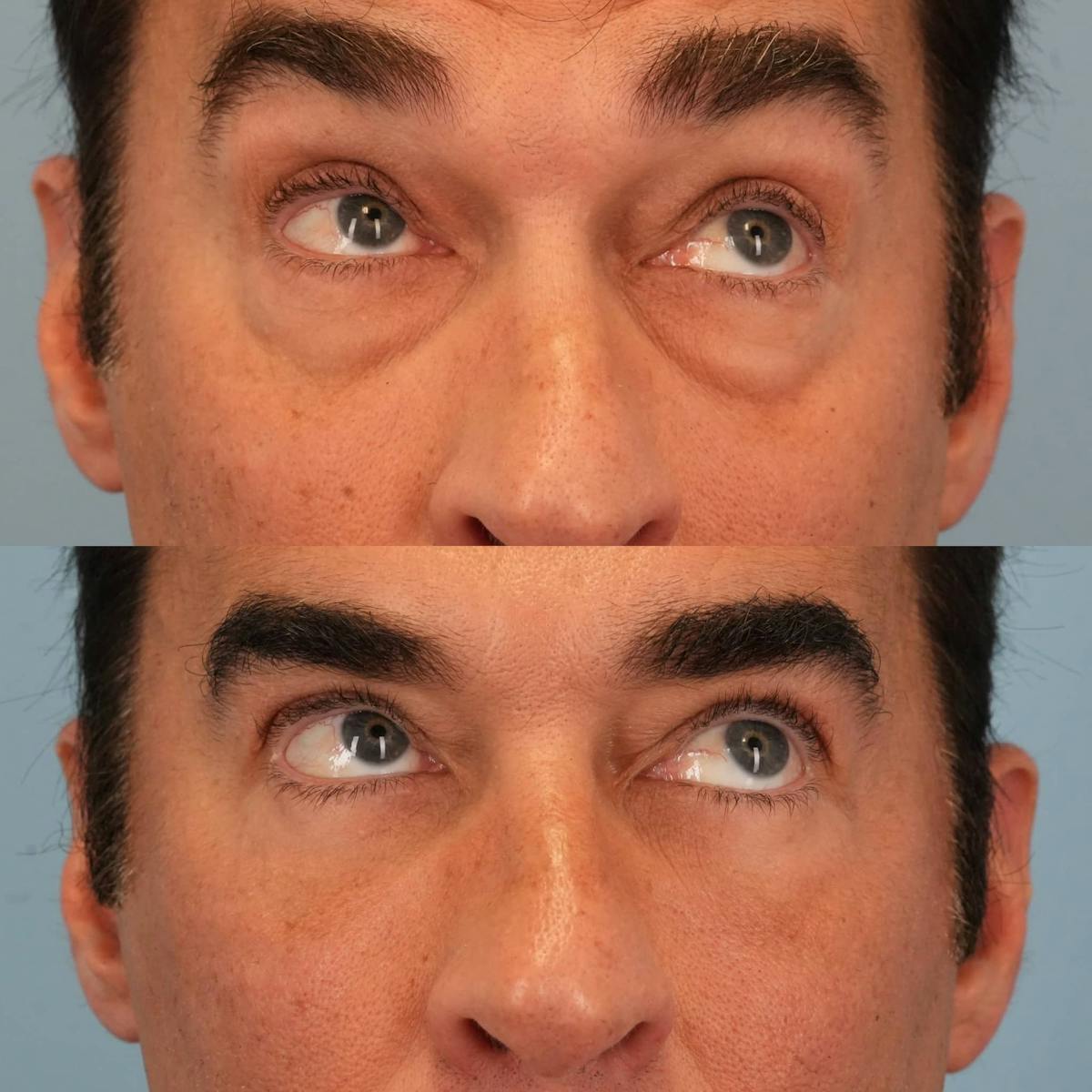 Lower Eyelids Before & After Gallery - Patient 403392 - Image 4