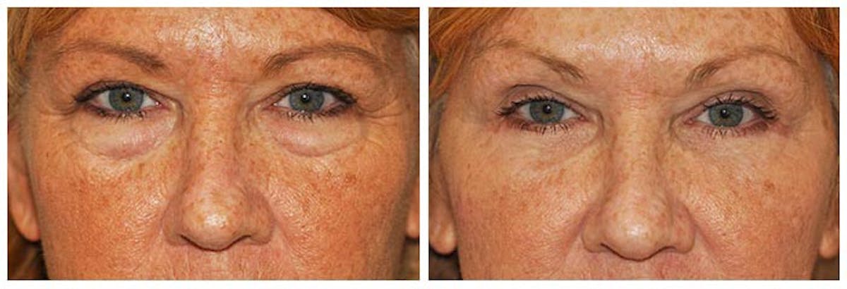 Lower Eyelids Before & After Gallery - Patient 372968 - Image 1