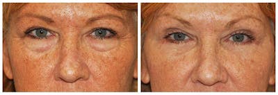Lower Eyelids Before & After Gallery - Patient 372968 - Image 1