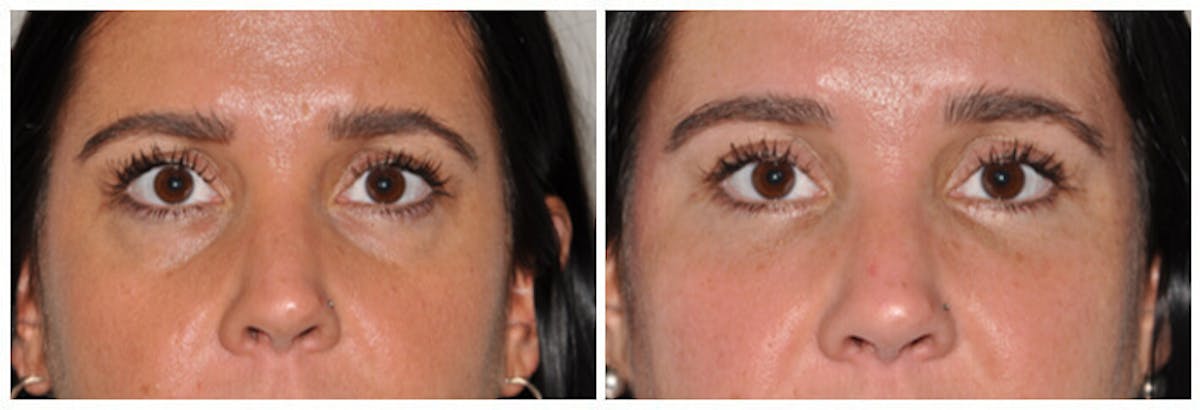 Lower Eyelids Before & After Gallery - Patient 291285 - Image 1