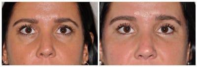 Lower Eyelids Before & After Gallery - Patient 291285 - Image 1